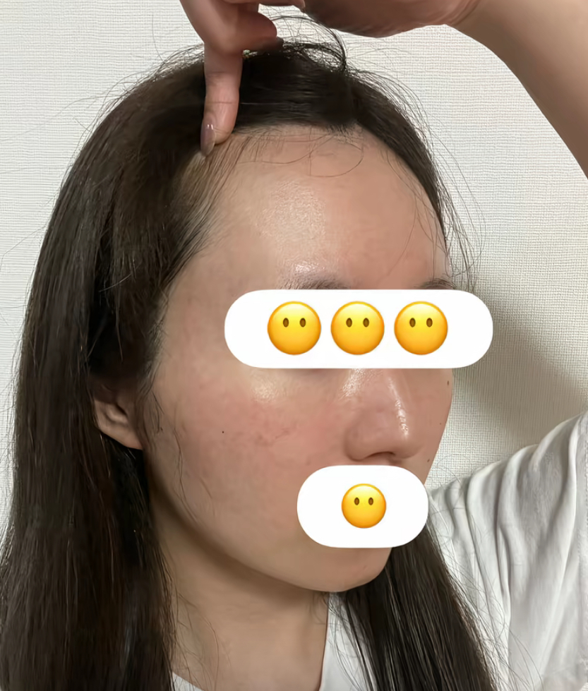 イソトレチノイン服用 約6ヶ月後の肌の状態